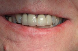 Patient mouth before teeth correction