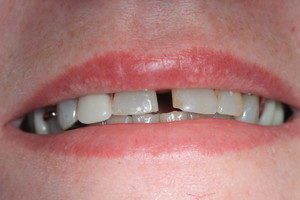Before veneers and teeth correction
