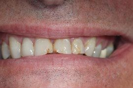 Teeth correction by Georgia Knotek, DDS