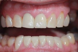 Patient mouth after cosmetic dentistry by Georgia Knotek, DDS