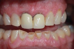 Patient mouth before cosmetic dentistry by Georgia Knotek, DDS